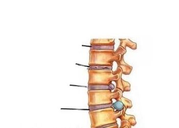 Štiri stopnje razvoja osteohondroze